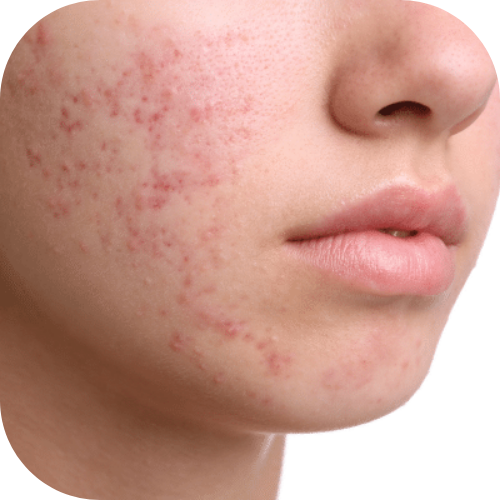 Acne Control