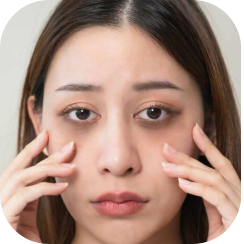 Undereye Dark Circle